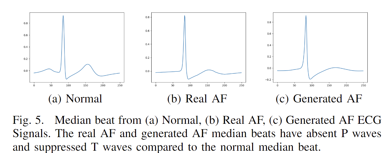 Median beat from (a) Normal, (b) Real AF, (c) Generated AF ECG Signals. The real AF and generated AF median beats have absent P waves and suppressed T waves compared to the normal median beat.